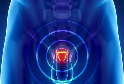 प्रोस्टेट समस्या